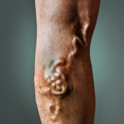 Dr Ron Lev, MD - Advanced Varicose Vein Treatments, New York City